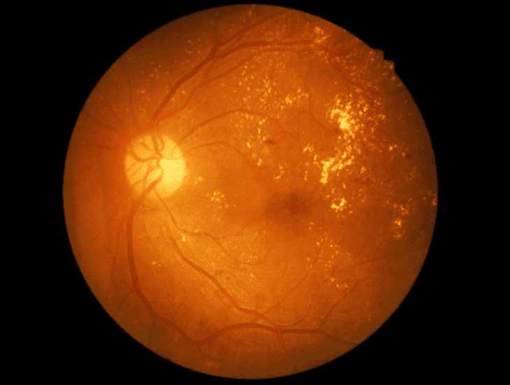 Retina Image of a Person with Diabetic Retinopathy"